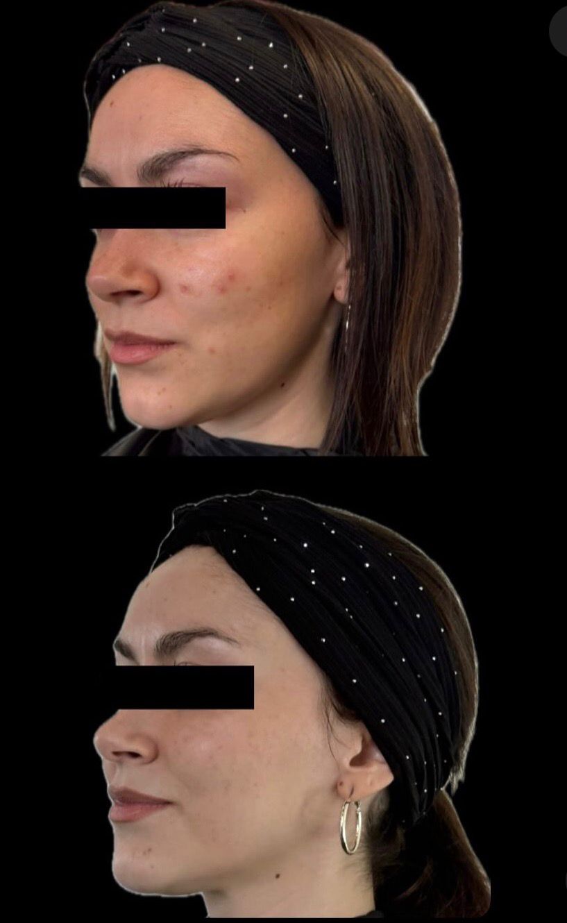 Resultado real de ADN de salmón — antes y después · Dubless Esthetic