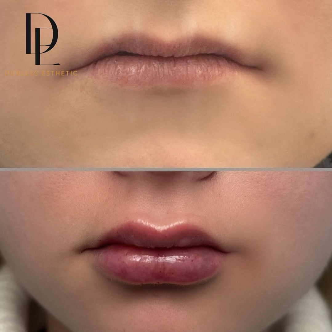 Resultado real de Aumento de labios — antes y después · Dubless Esthetic