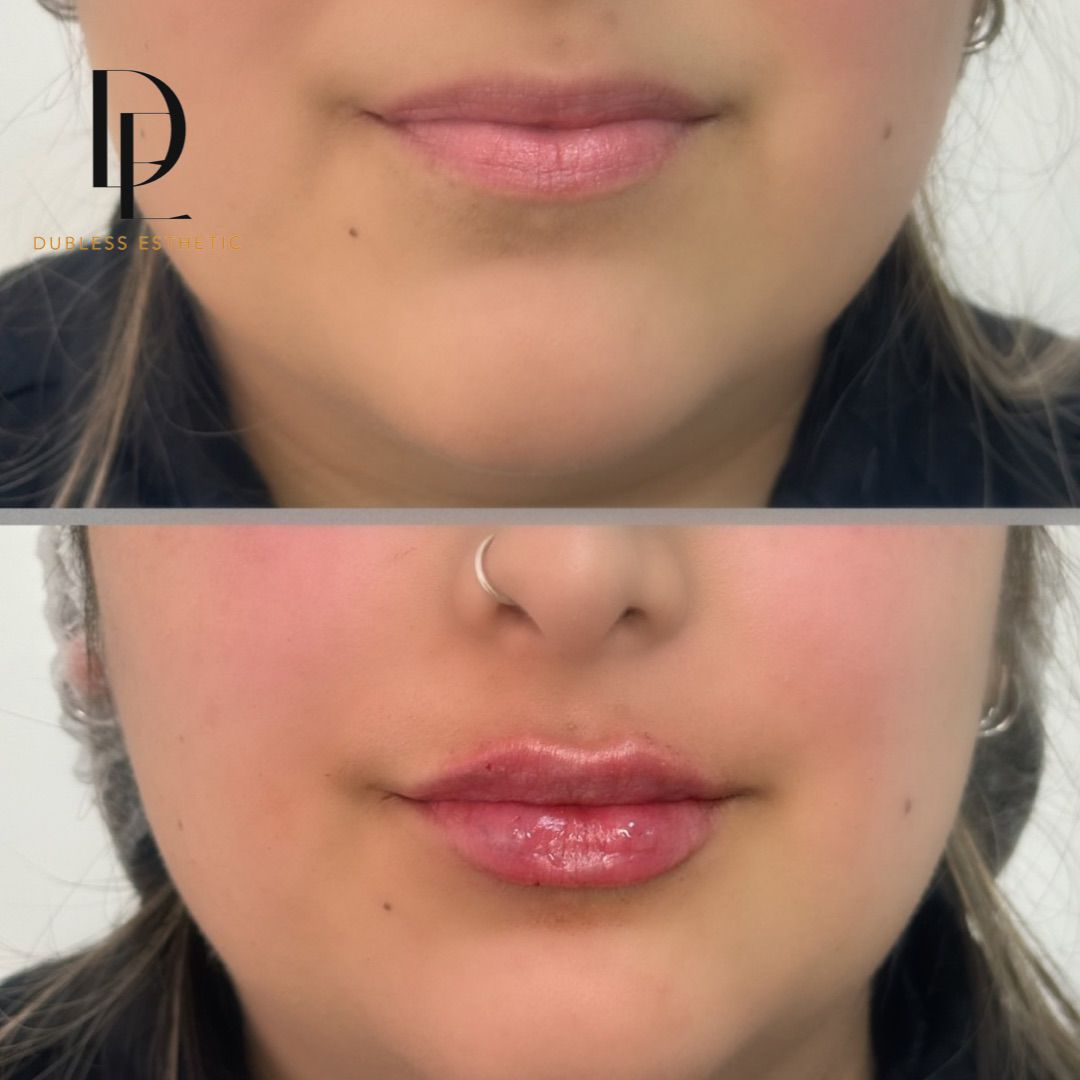 Resultado real de Aumento de labios — antes y después · Dubless Esthetic
