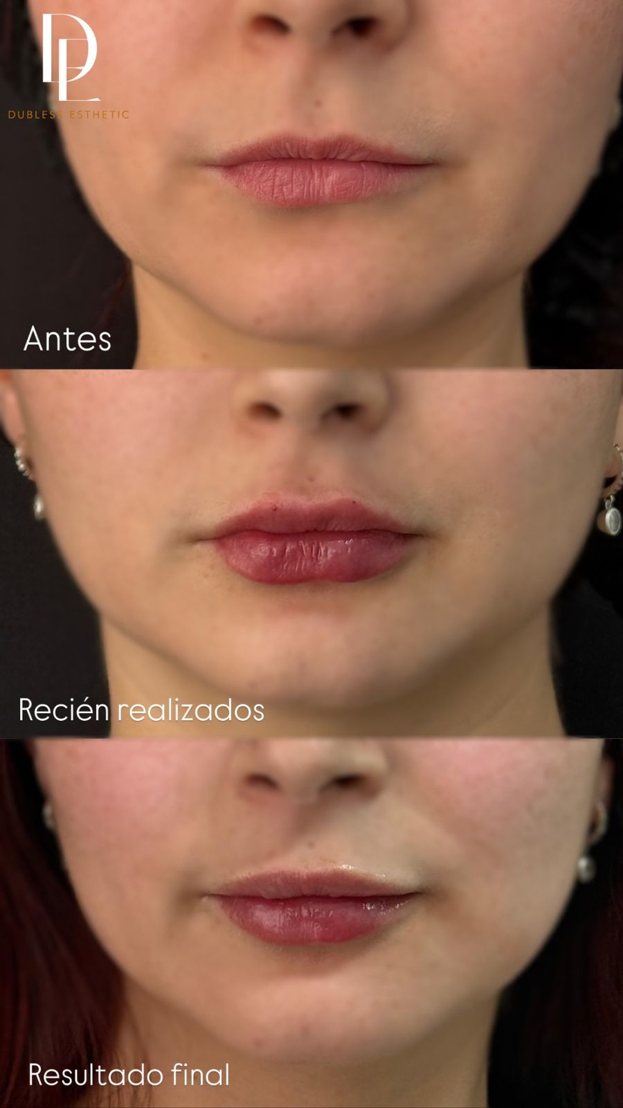 Resultado real de Aumento de labios — antes y después · Dubless Esthetic