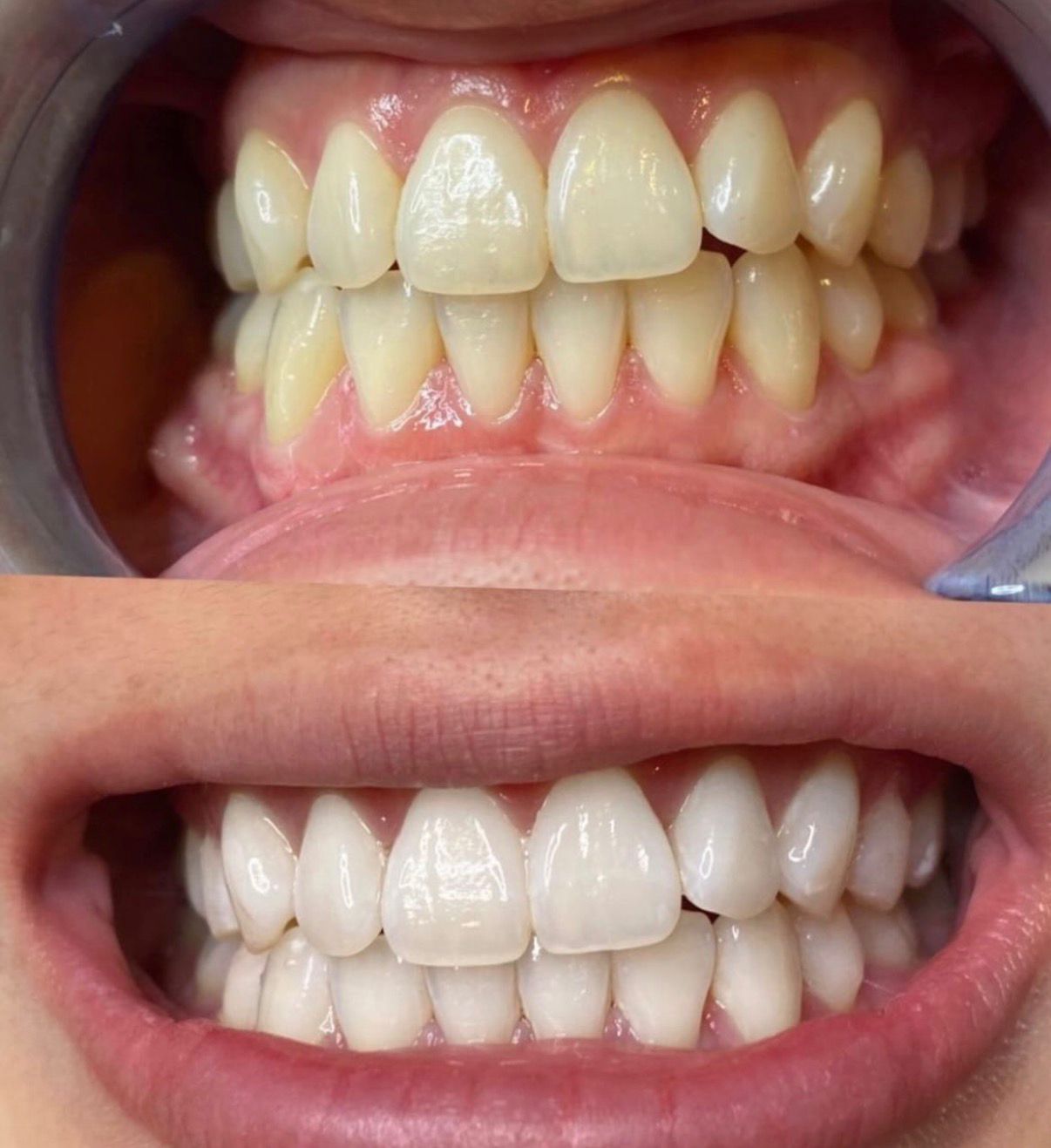 Resultado real de Blanqueamiento dental — antes y después · Dubless Esthetic
