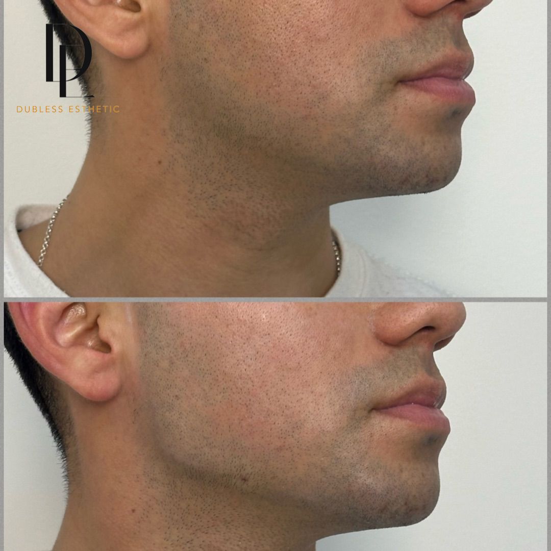 Resultado real de Contorno mandibular — antes y después · Dubless Esthetic