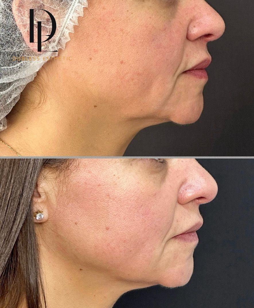 Resultado real de HIFU facial — antes y después · Dubless Esthetic