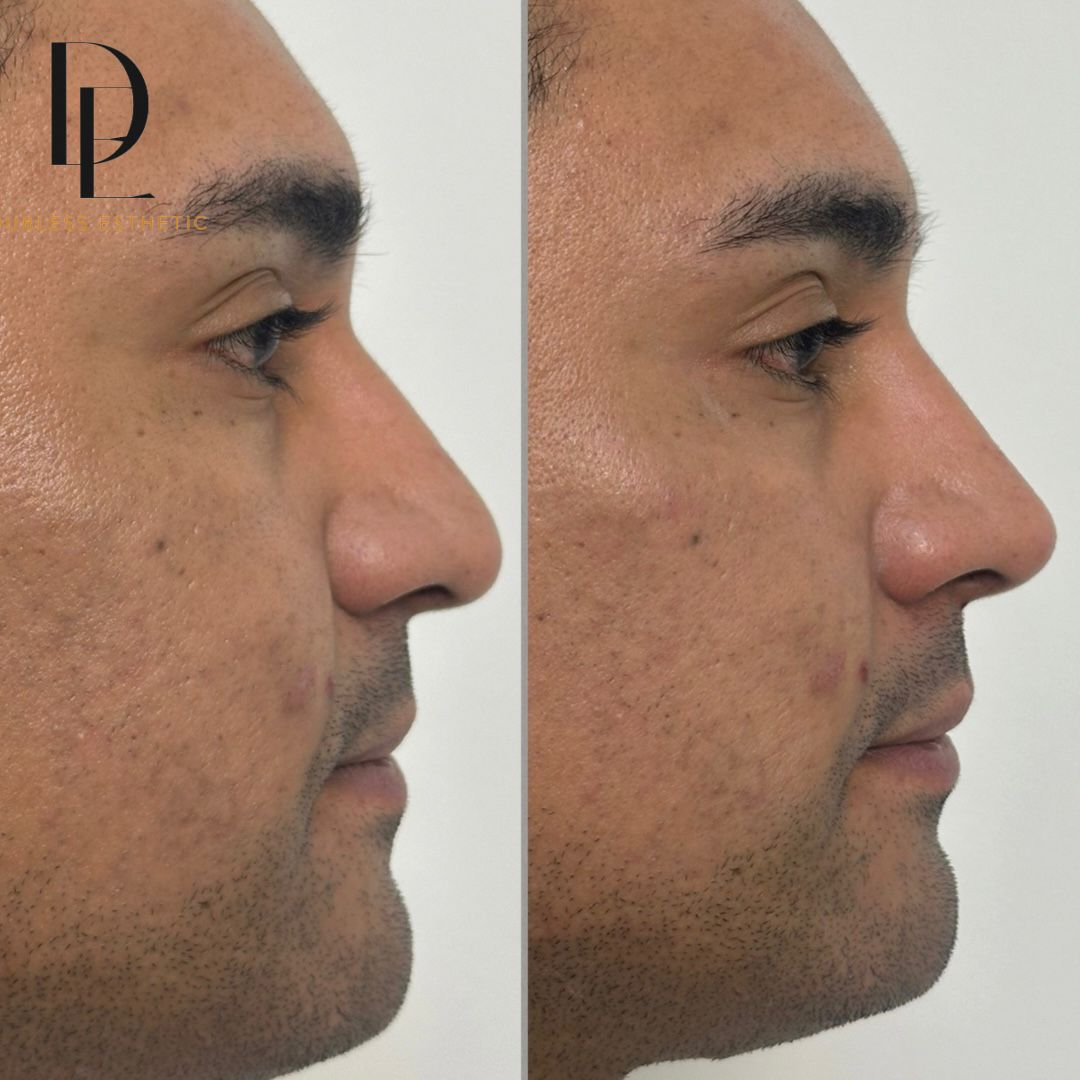 Resultado real de Rinomodelación — antes y después · Dubless Esthetic