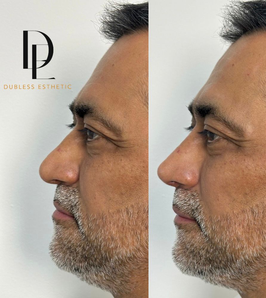 Resultado real de Rinomodelación — antes y después · Dubless Esthetic
