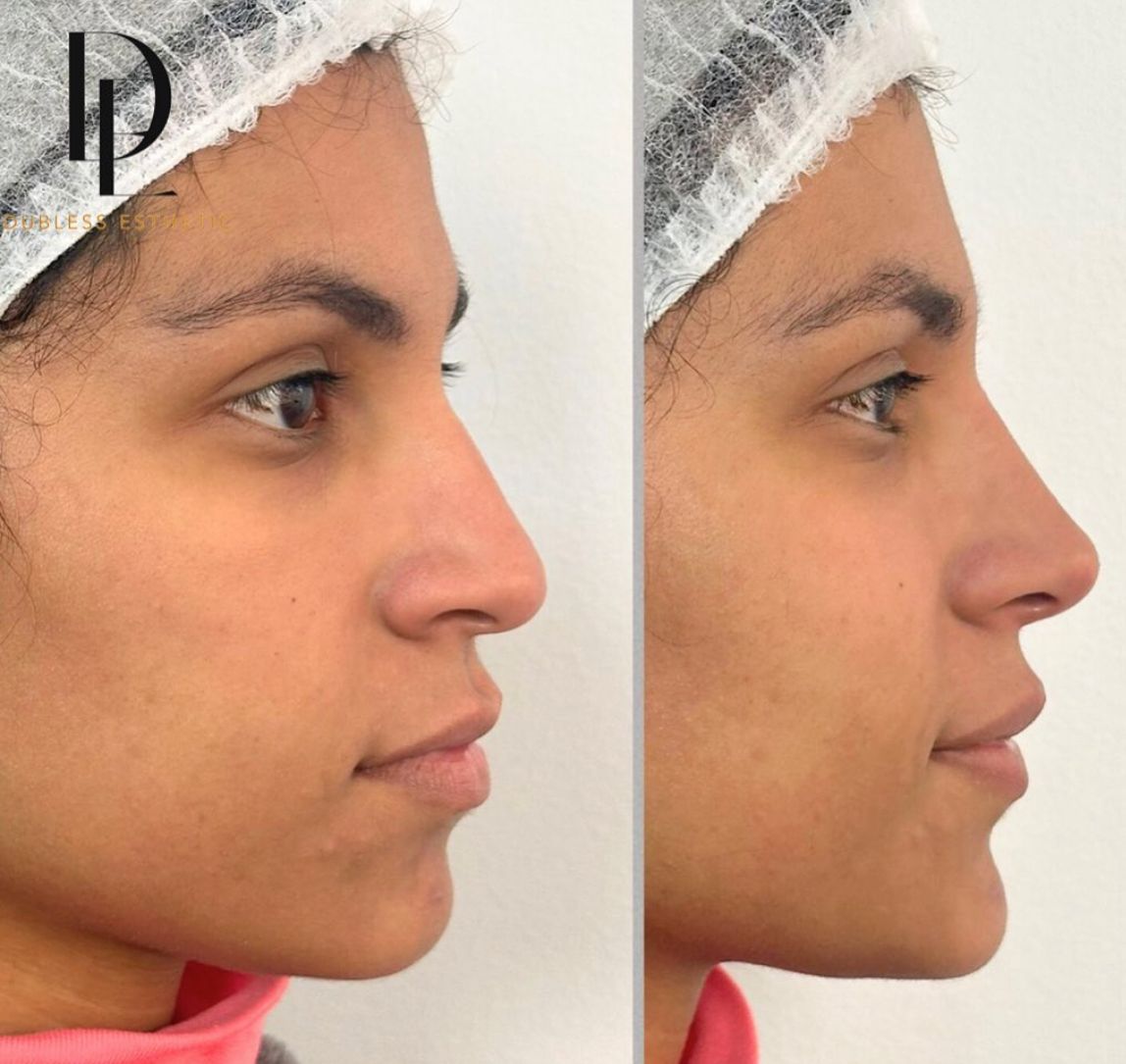 Resultado real de Rinomodelación — antes y después · Dubless Esthetic