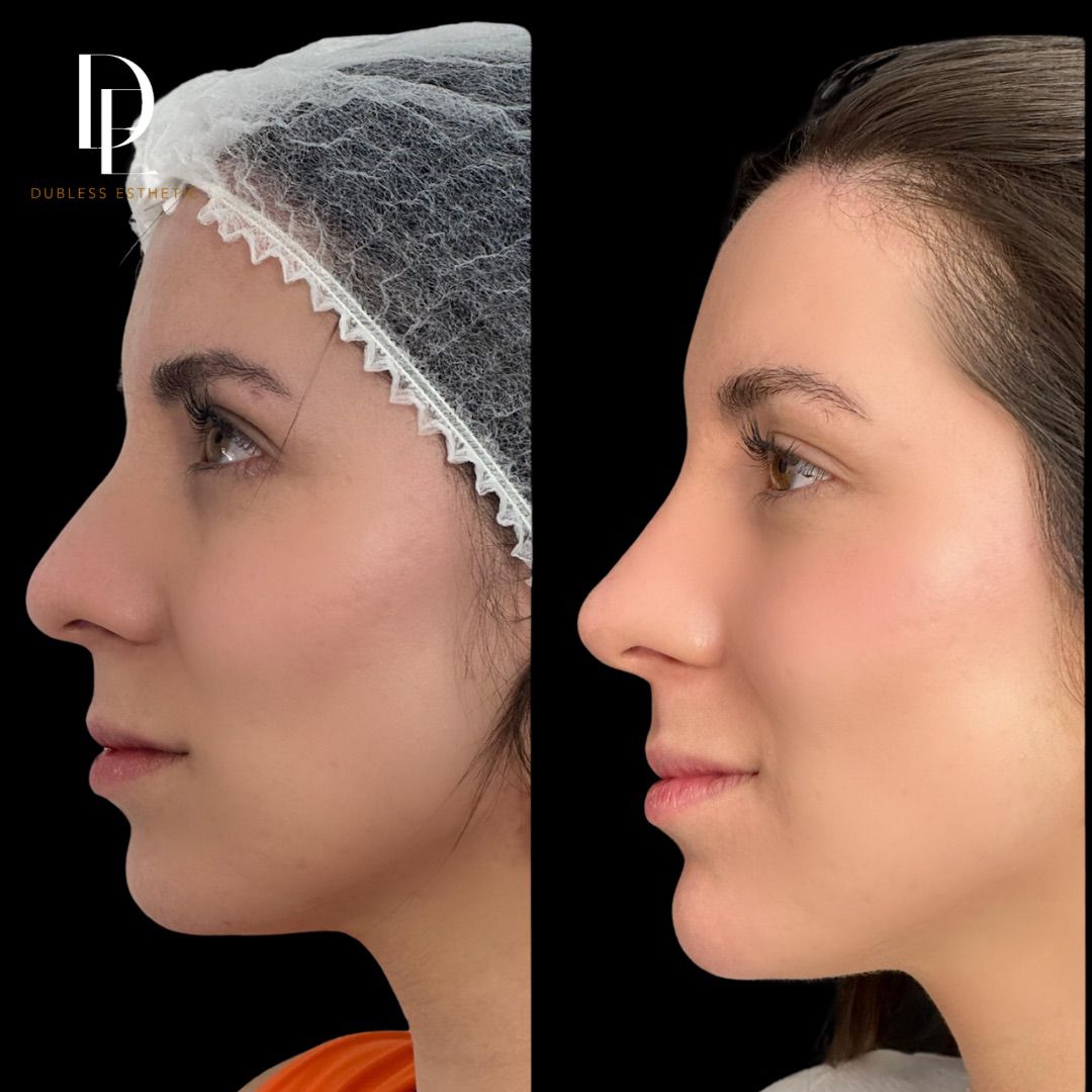 Resultado real de Rinomodelación — antes y después · Dubless Esthetic