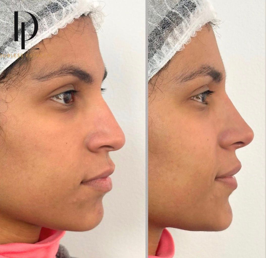 Resultado real de Rinomodelación — antes y después · Dubless Esthetic