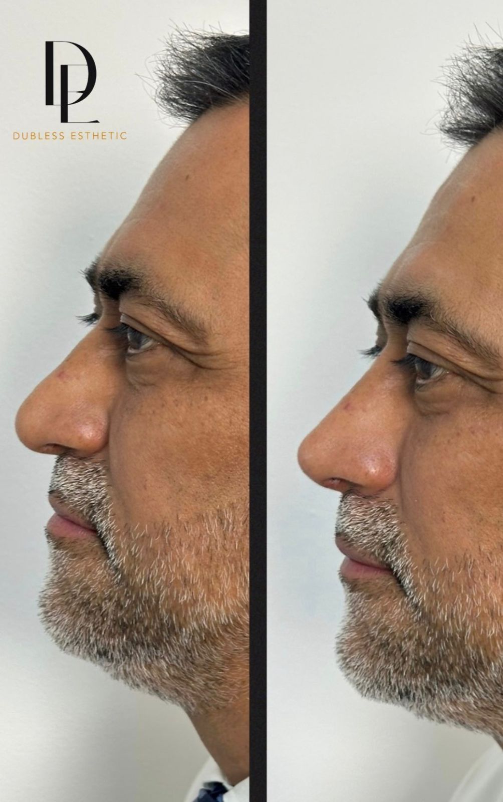 Resultado real de Rinomodelación — antes y después · Dubless Esthetic