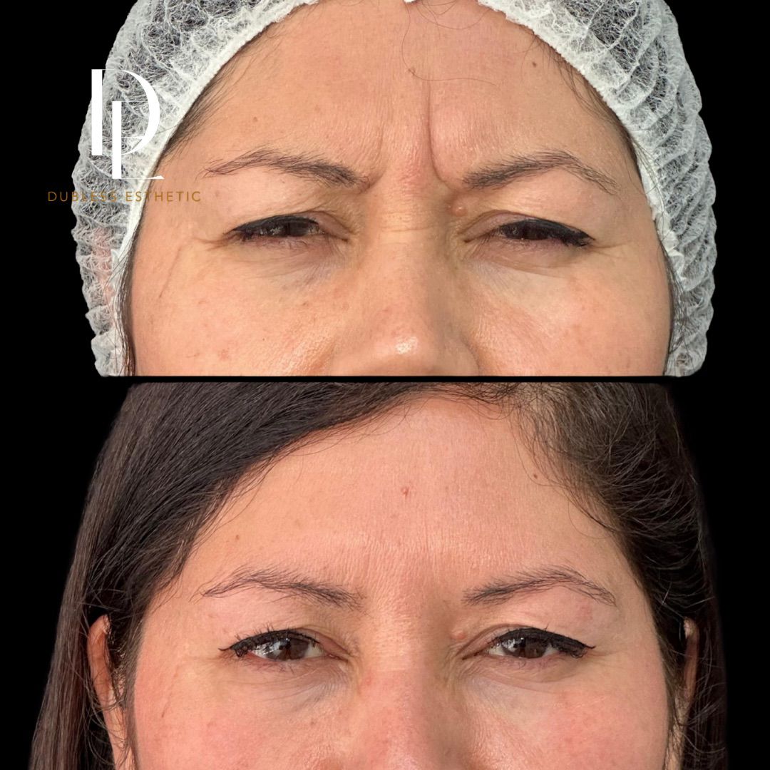 Resultado real de Toxina botulínica · Dysport — antes y después · Dubless Esthetic
