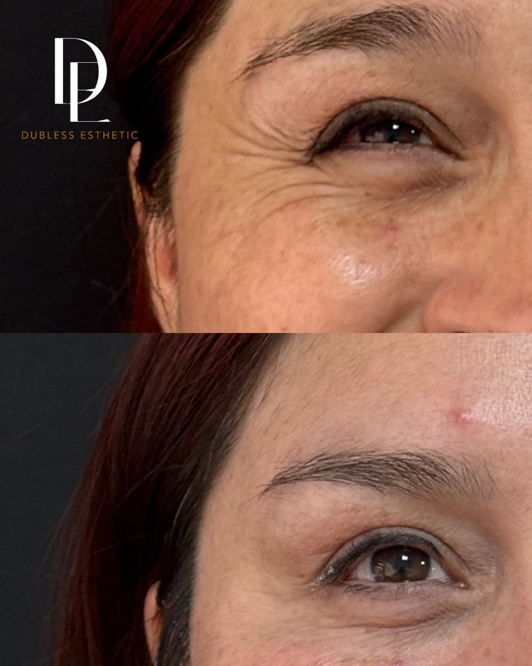 Resultado real de Toxina botulínica · Dysport — antes y después · Dubless Esthetic