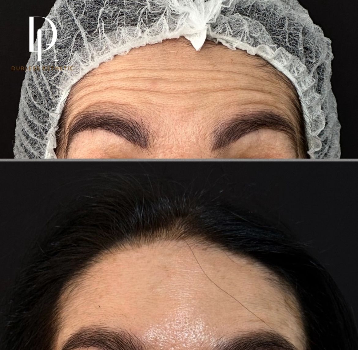 Resultado real de Toxina botulínica · Dysport — antes y después · Dubless Esthetic