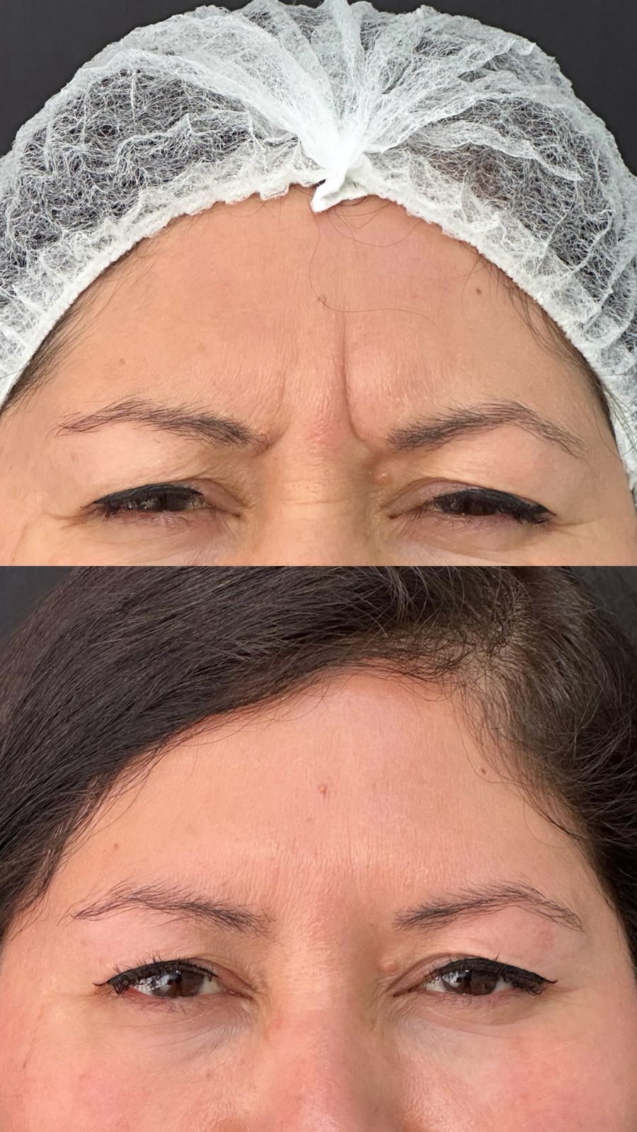 Resultado real de Toxina botulínica · Dysport — antes y después · Dubless Esthetic