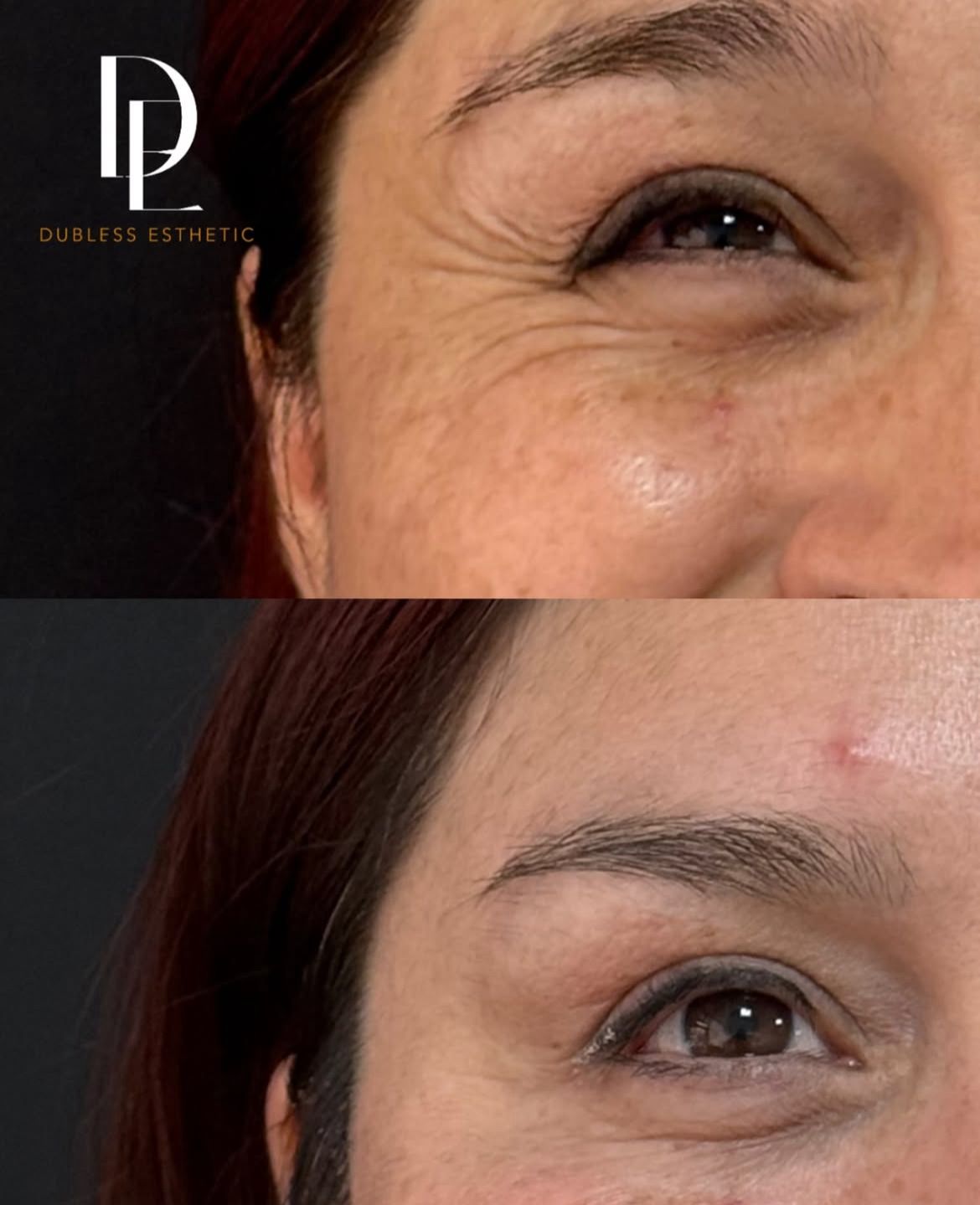 Resultado real de Toxina botulínica · Dysport — antes y después · Dubless Esthetic